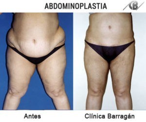 Abdominoplastia - Centro de Medicina y Cirugía Estética Manzanares