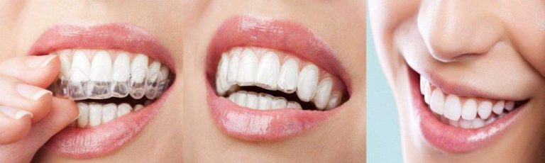 Ortodoncia Invisible Invisalign Cirugía Estética Medicina Estética y Odontología